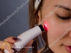 เลเซอร์หน้าใส - เลเซอร์พกพา (Soft Laser) ลดรอยสิว รอยดำ รอยแดง ริ้วรอย 